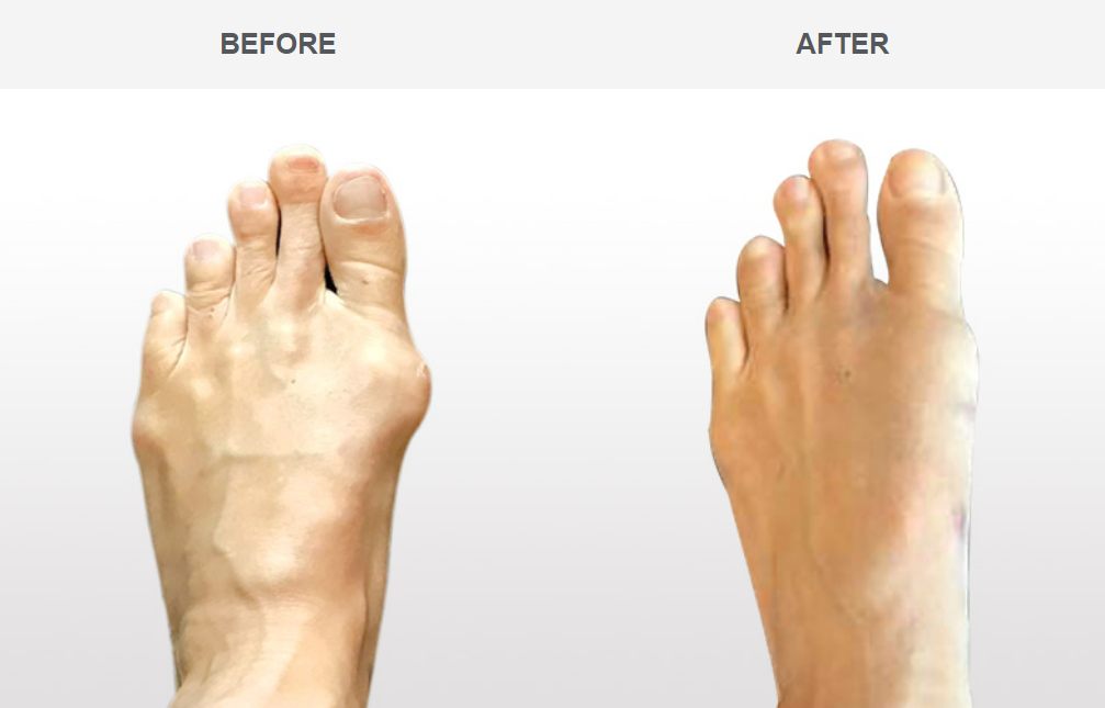 Bunion before and after surgery